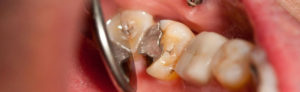 Dental fillings, inlays and onlays sunshine coast