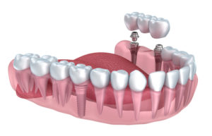 Dental Implant Surgery Sunshine Coast Buderim