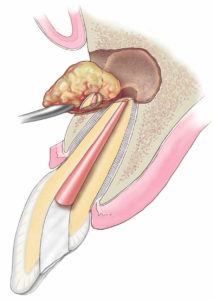 Root Canal Treatment Sunshine Coast