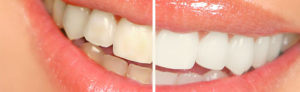 Before and after teeth whitening at Budi Dental Buderim